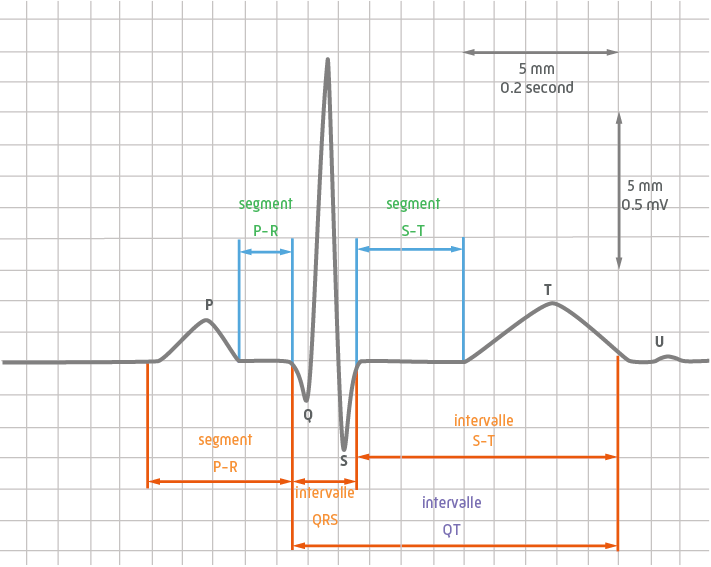 Analyse d'un électrocardiogramme - ECG