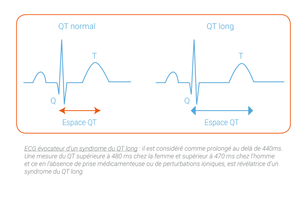 dessins dépression, ECG d'un syndrome du QT long