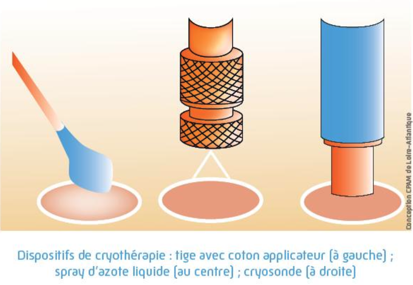 Dispositif de Cryothérapie