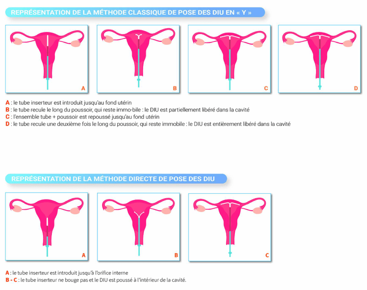 DIU pose méthode classique